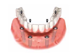 上顎または下顎の歯が全てない場合(ノーベルガイドを用いたオール・オン4)イメージ