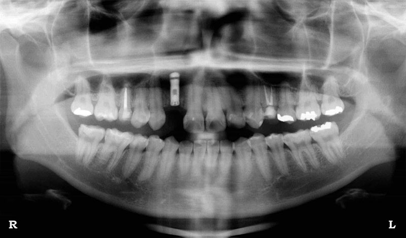 症例①インプラント治療後のレントゲン写真