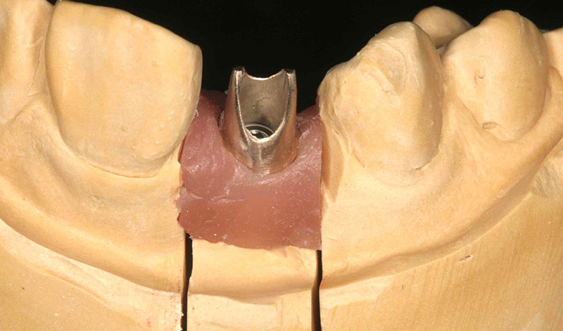 症例①ゴールドアバットメントの埋め込み