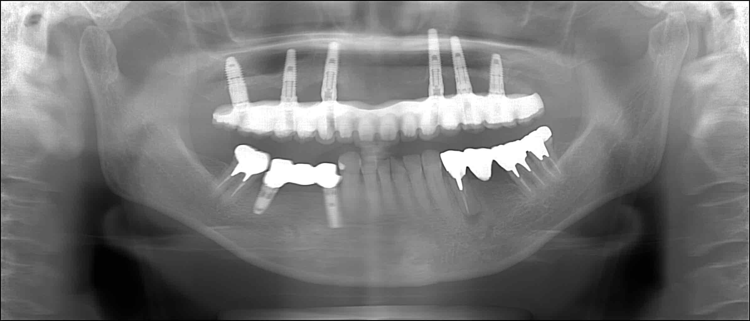 症例③オールオン6治療後のレントゲン写真