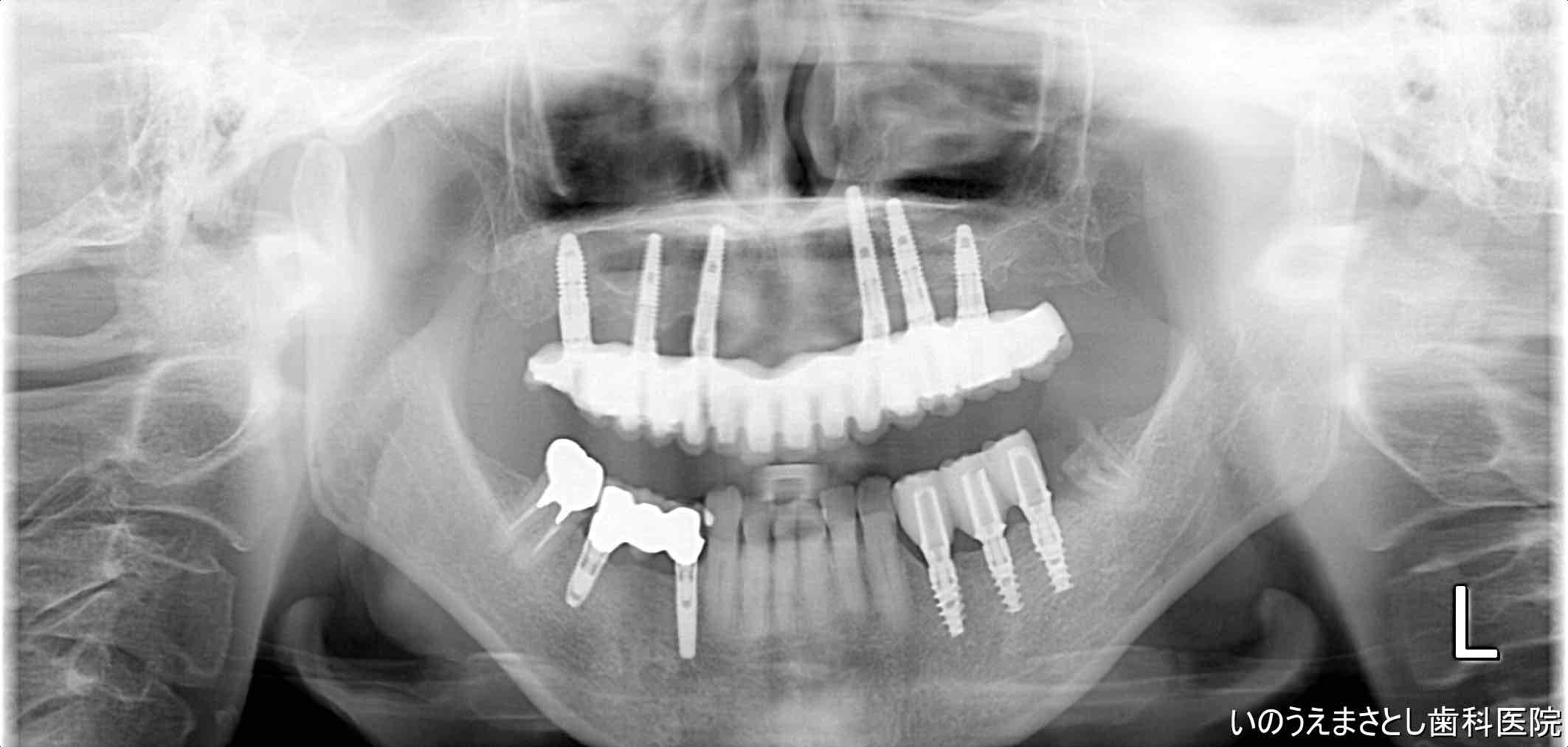 症例③オールオン6治療12年後のレントゲン写真