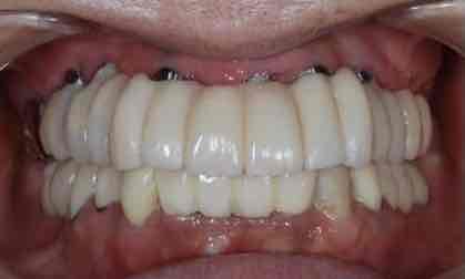 症例④上顎の即時負荷インプラント手術当日の仮歯