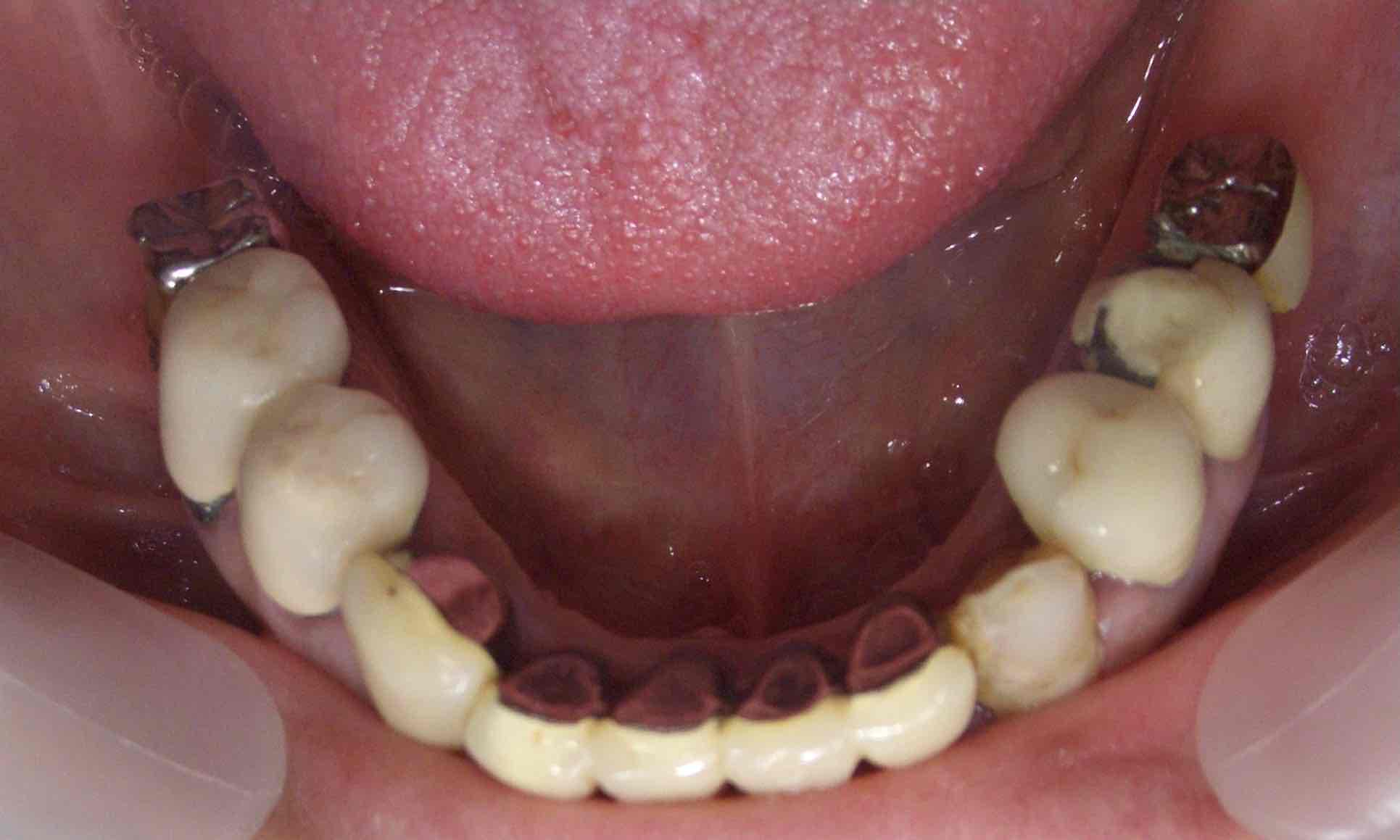 症例④下顎のインプラント治療前の写真