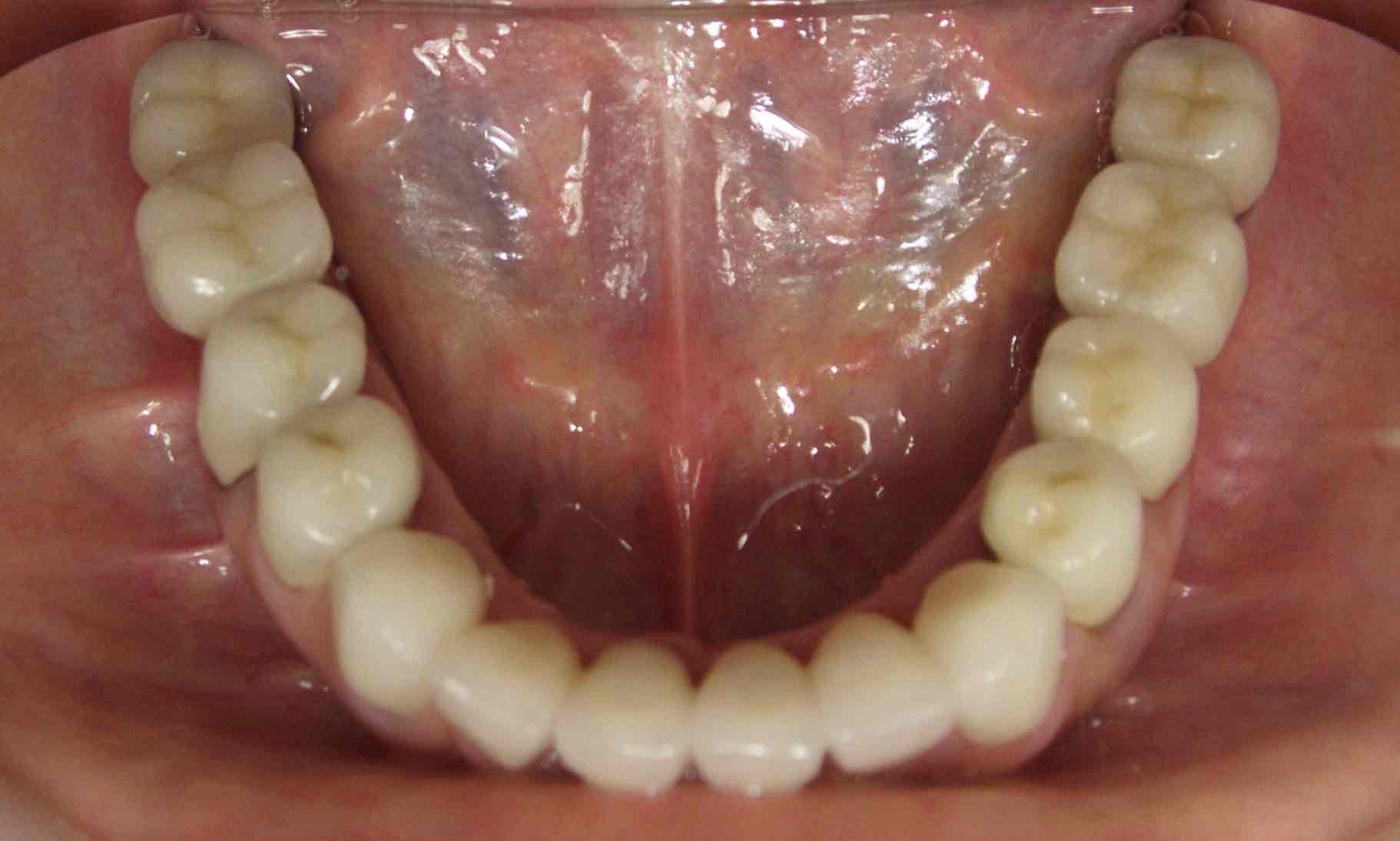 症例④下顎のインプラント治療後の写真