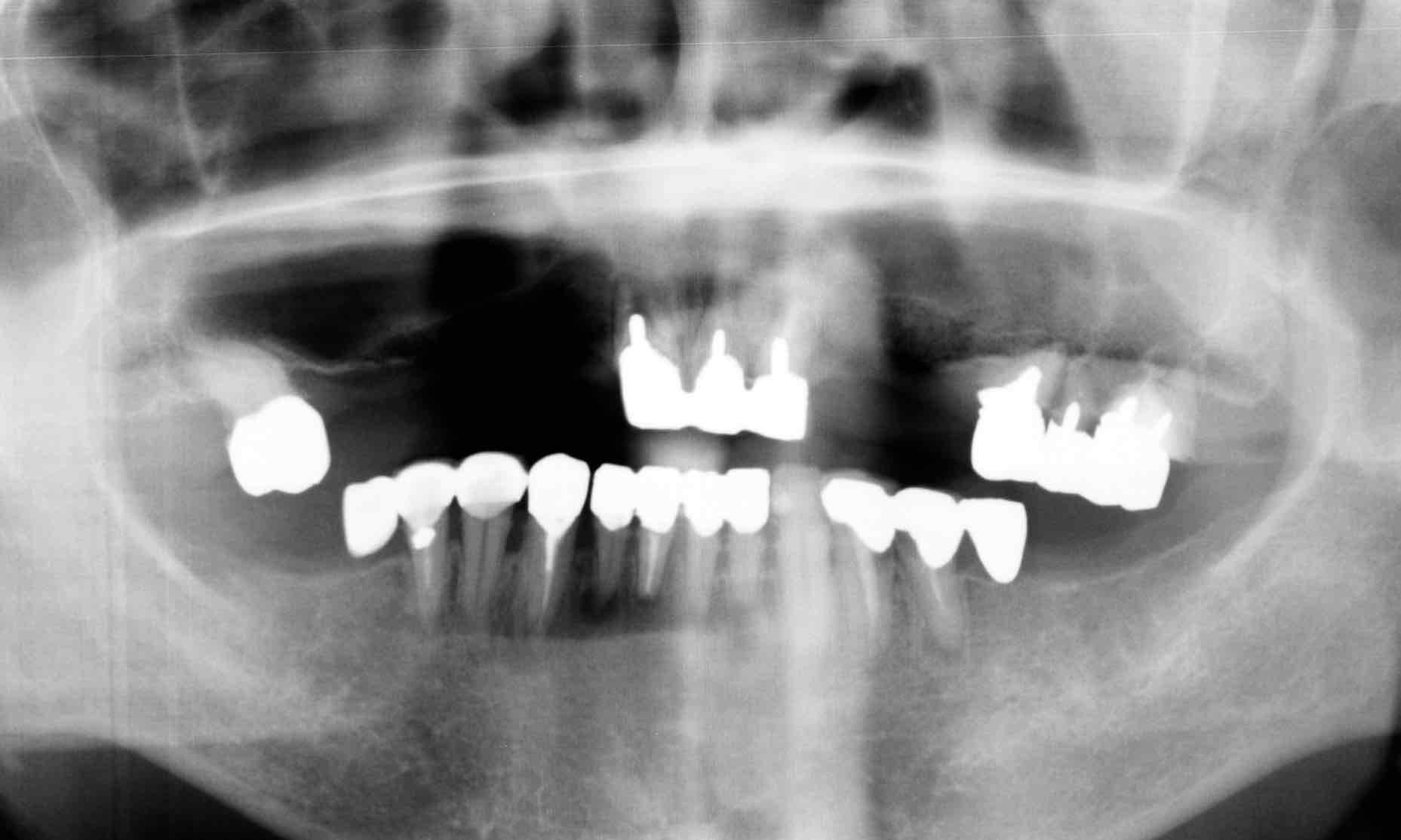 症例④インプラント治療前のレントゲン写真