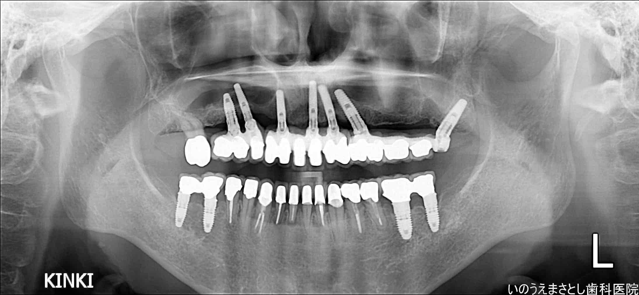症例④インプラント治療後のレントゲン写真