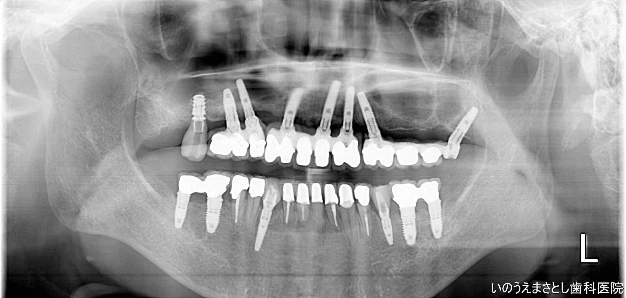 症例④インプラント治療10年後のレントゲン写真