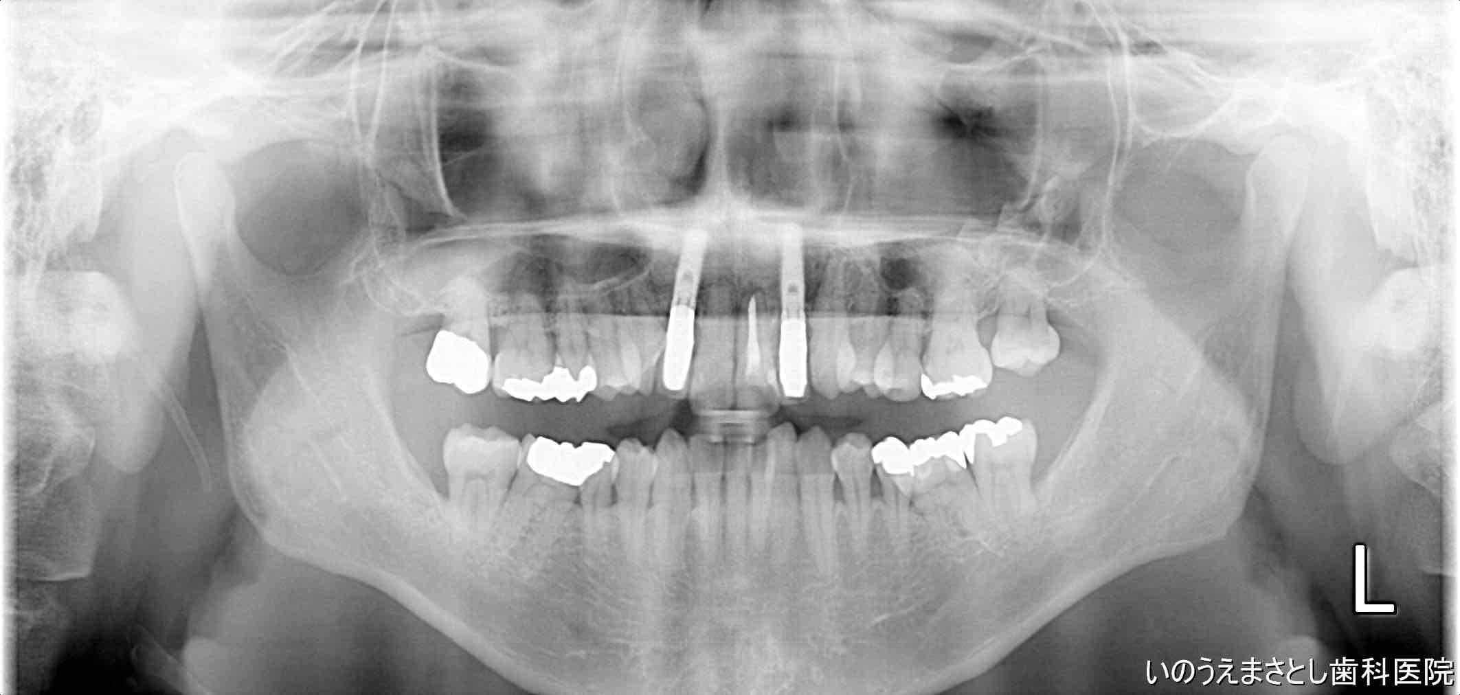 症例⑤インプラント治療10年後のレントゲン写真