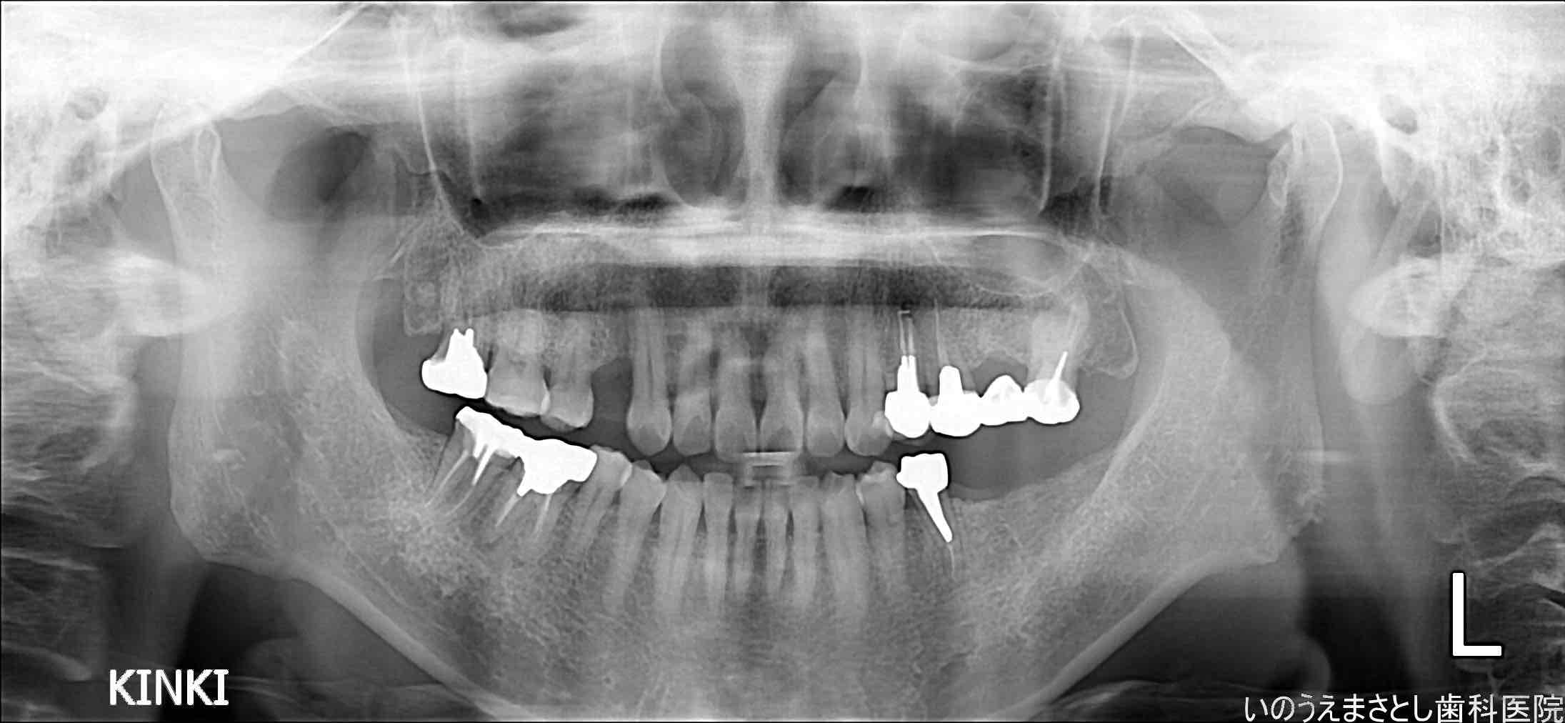 症例②インプラント治療前のレントゲン写真