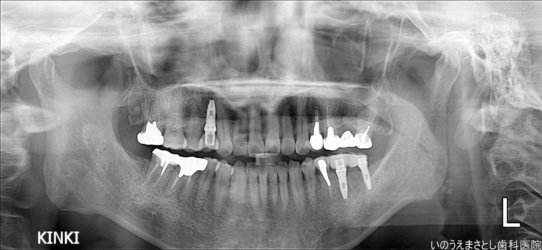 症例②インプラント治療後のレントゲン写真