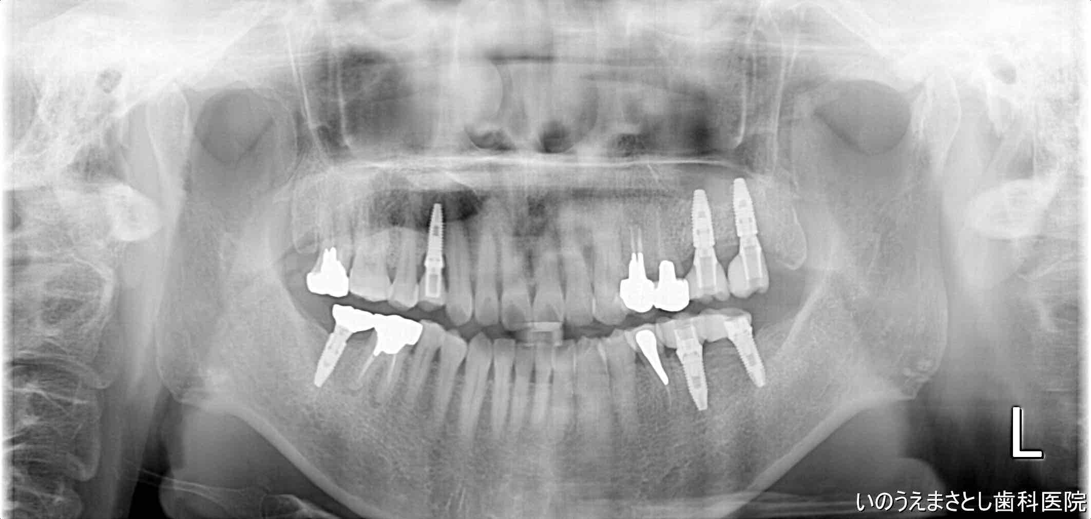 症例②インプラント治療7年後のレントゲン写真