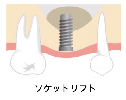 上顎の奥歯が1本ない場合(ソケットリフト法を用いて1本埋入)イメージ