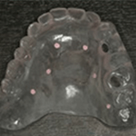 インプラントのCT撮影の画像