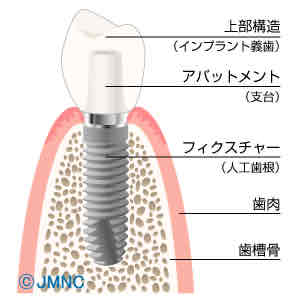 インプラントの構造