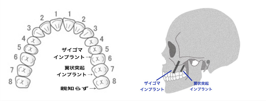 ザイゴマインプラントと翼状突起インプラント