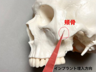 ザイゴマインプラント