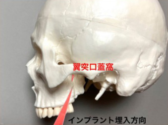 翼状突起インプラント