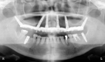翼状突起インプラント