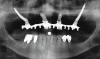 ザイゴマインプラント
