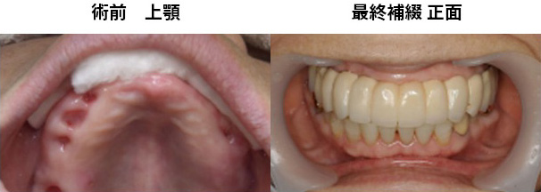 術前 上顎最終補綴 正面