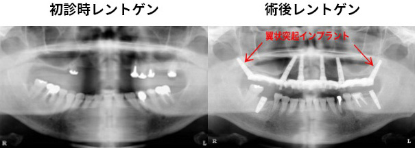 初診時レントゲン 術後レントゲン