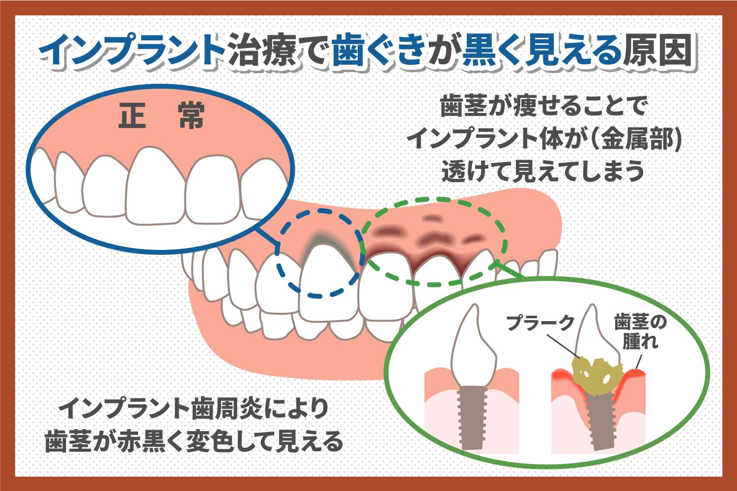 インプラント治療で歯茎が黒くなるのは本当？