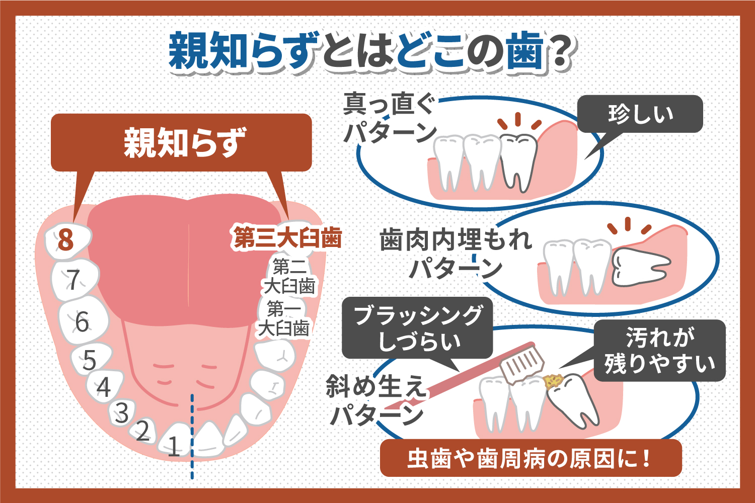 親知らず 虫歯 欠け た