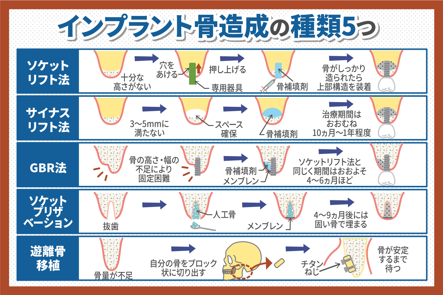 インプラント骨造成の種類を解説