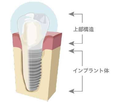 インプラントの構造