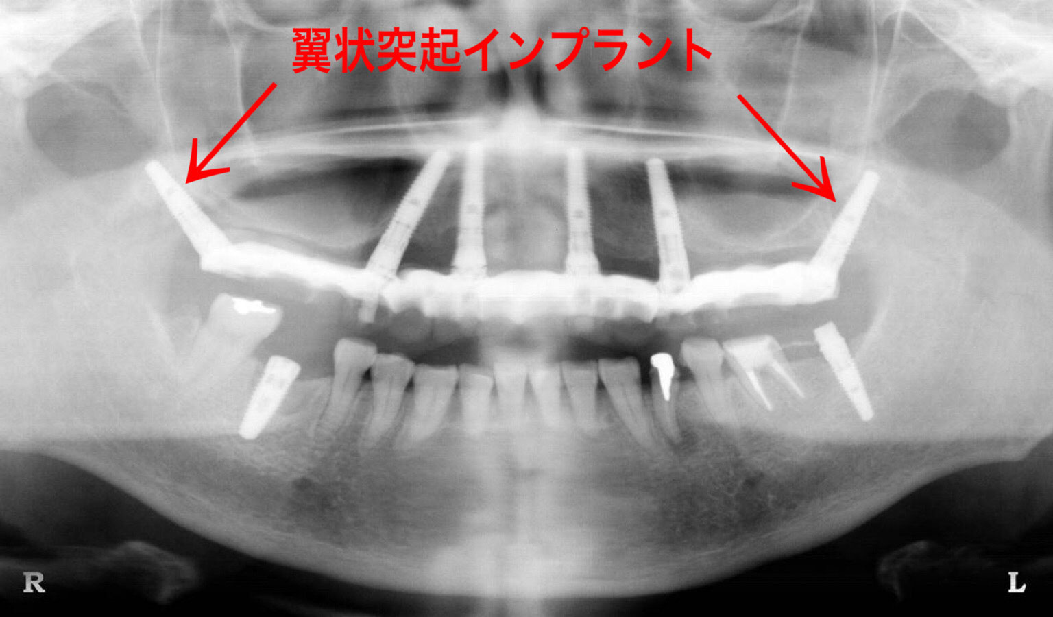 治療後　レントゲン