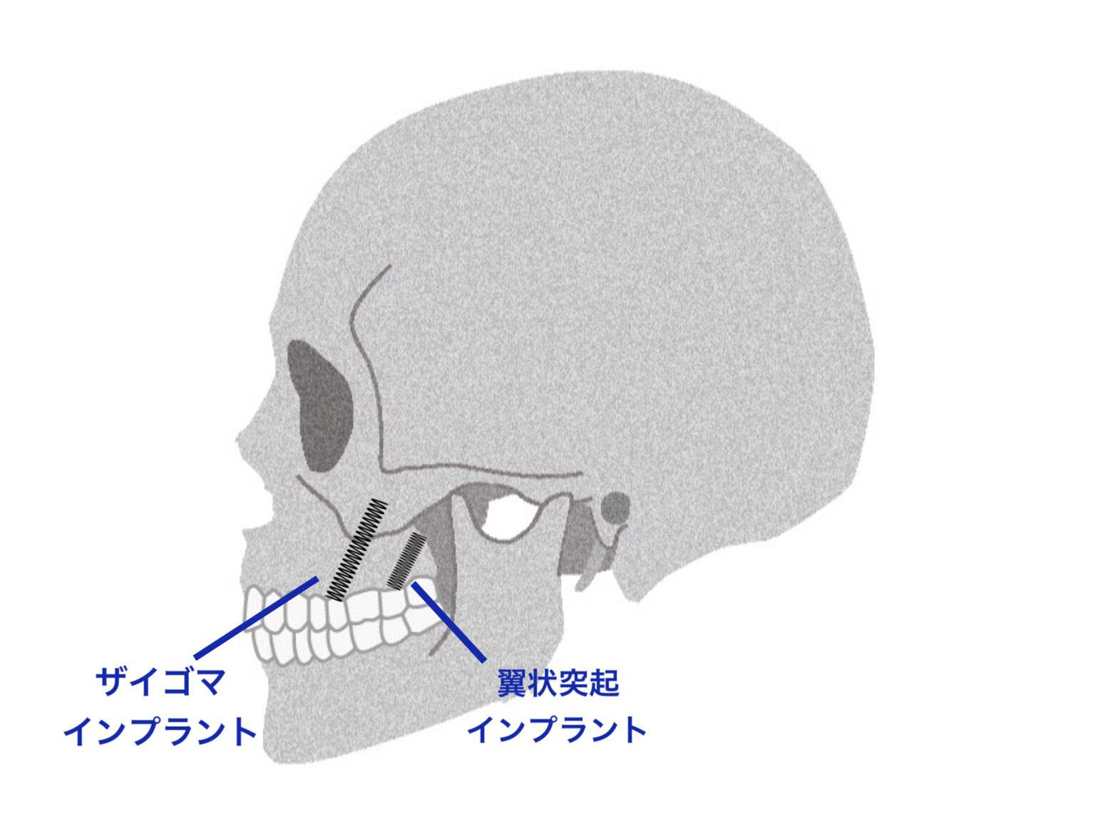 ザイゴマインプラントと翼状突起インプラントの比較