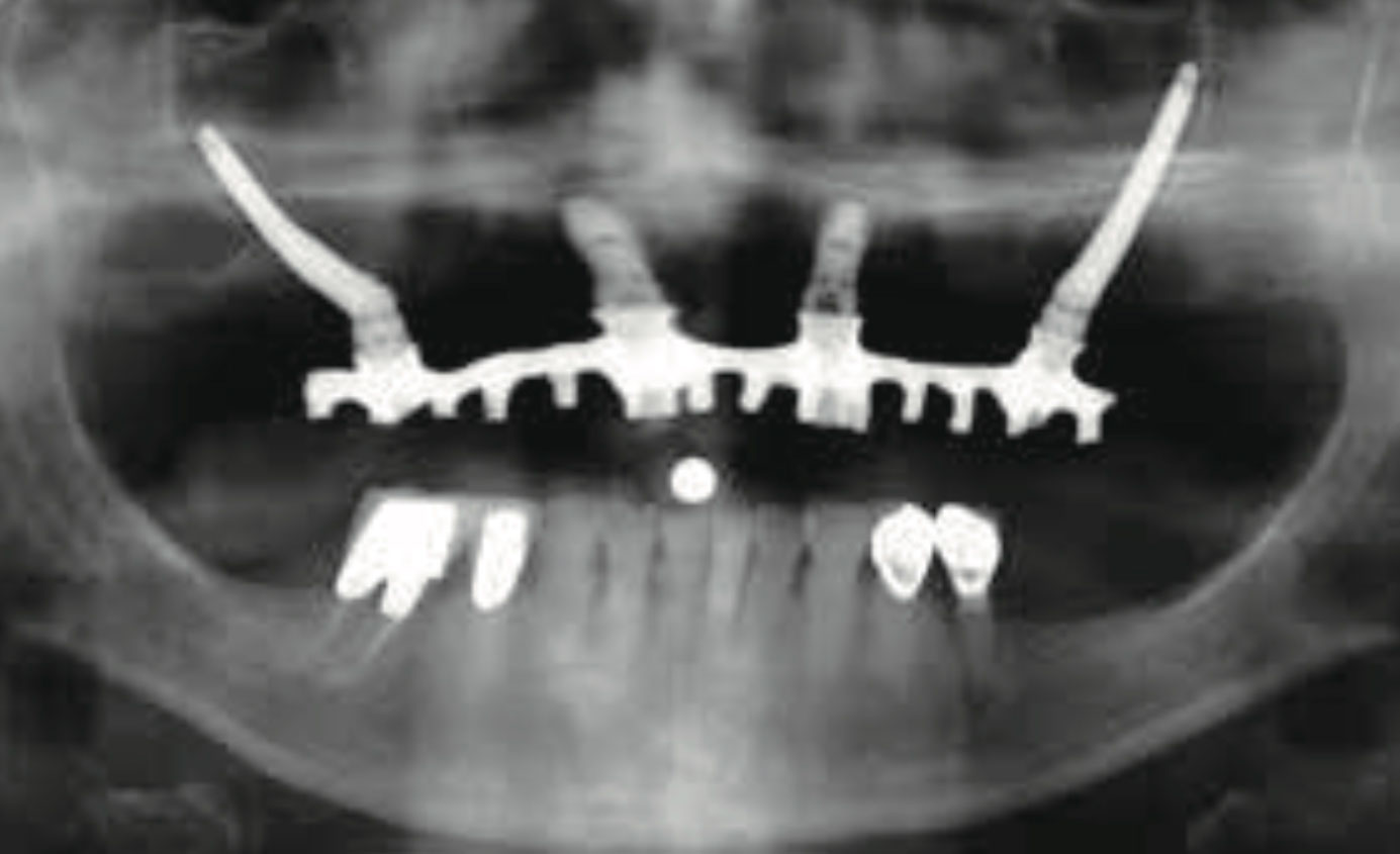 術後レントゲン(上顎)の一例 ザイゴマインプラント